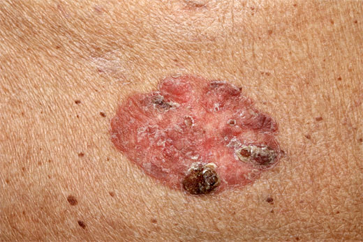 QUERATOSIS