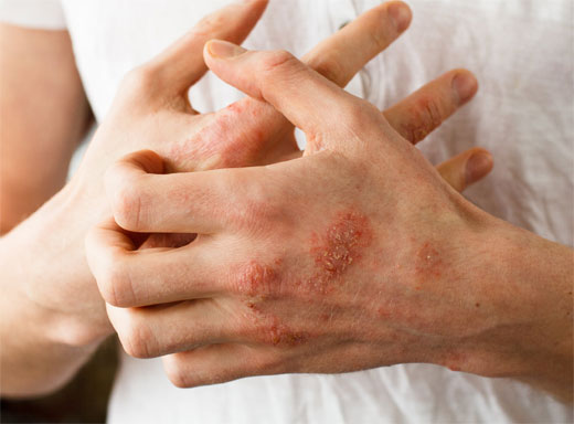 DERMATITIS ATOPICA