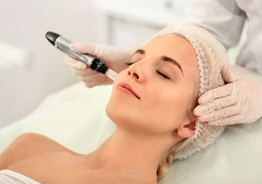 microneedling