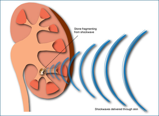 ondas de choque: ESWL