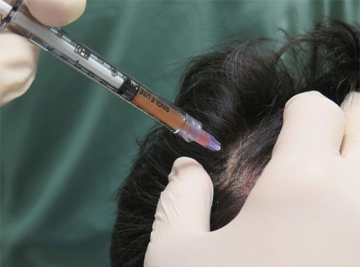 PRP: ALOPECIA